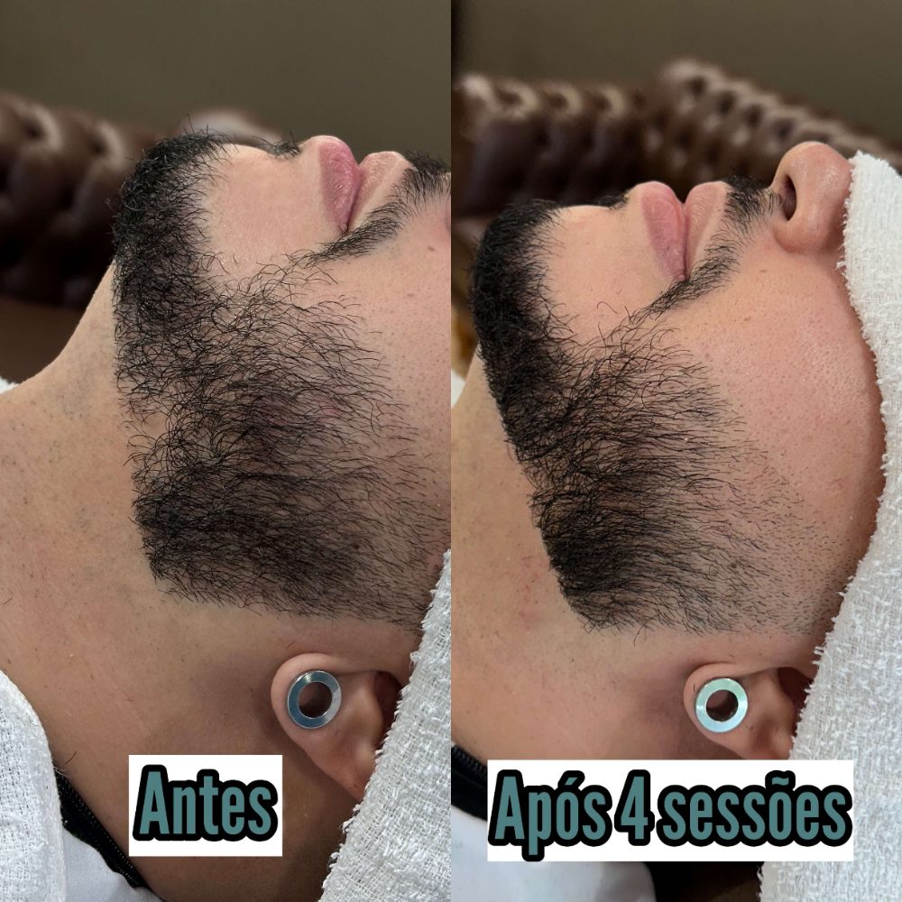 Fio Derma na barba: antes e após 4 sessões