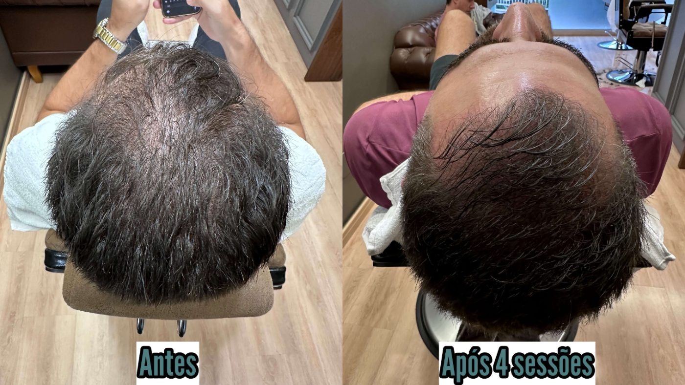 Fio Derma no couro cabeludo: antes e após 4 sessões